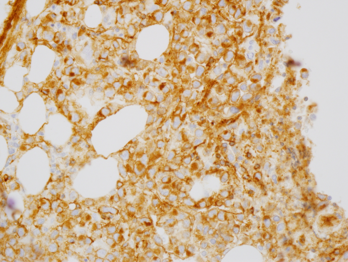 Fig. 8 Bone marrow core biopsy. By immunohistochemistry the cells expressed CD45, CD33 (Fig. 8a), muramidase (Fig. 8b), CD99 (Fig. 8c), and focal weak CD68 (Fig. 8d). CD34, CD117 and myeloperoxidase were negative.
